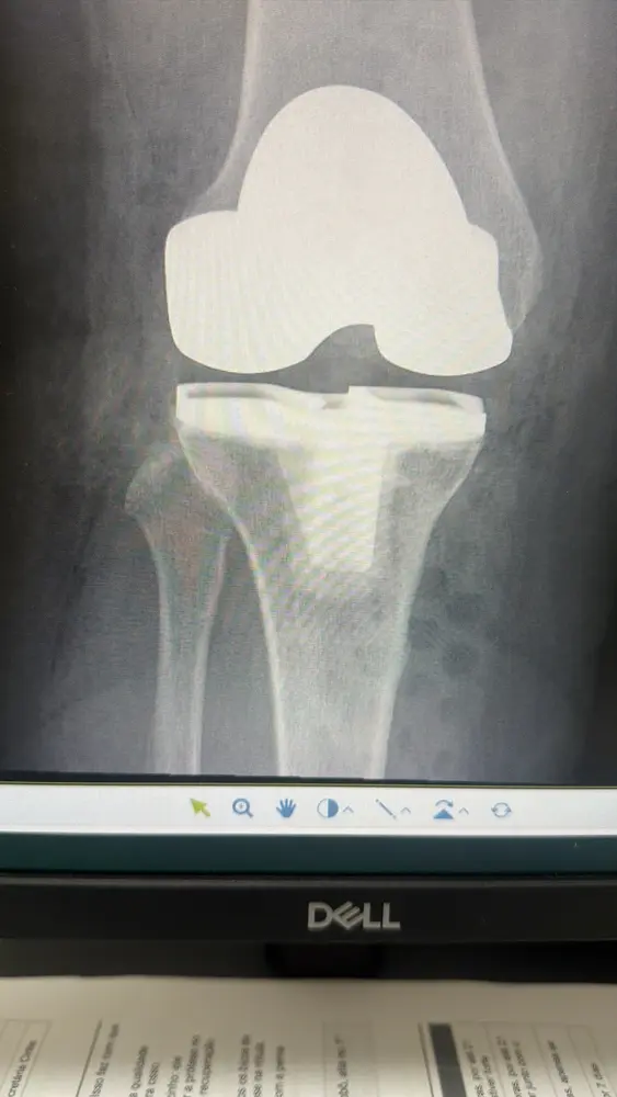Radiografia frontal de prótese do joelho